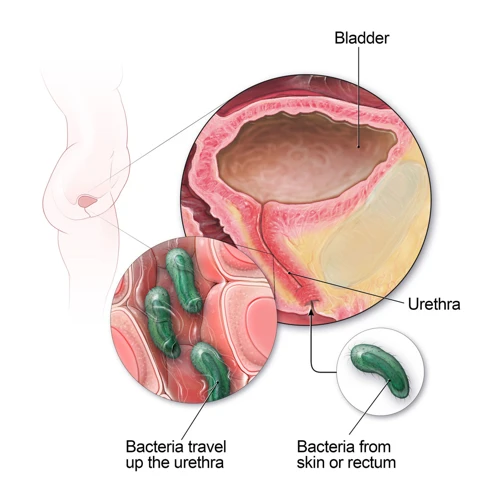 What Is A Urinary Tract Infection?